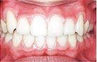 矯正治療後：歯を抜かない矯正治療（非抜歯矯正）